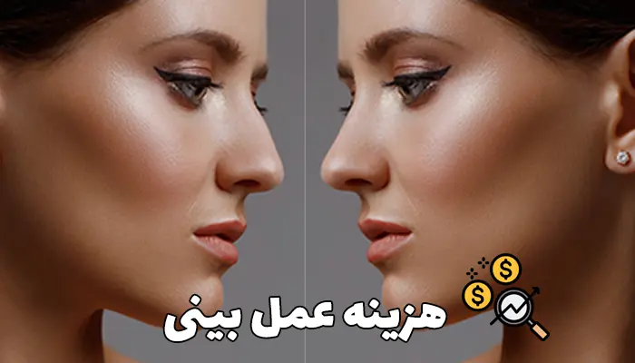 هزینه عمل بینی در 1404: عوامل تاثیرگذار بر قیمت عمل بینی کدامند؟