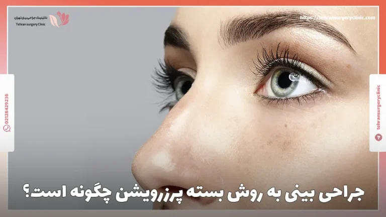 جراحی بینی به روش بسته پرزرویشن چگونه است؟
