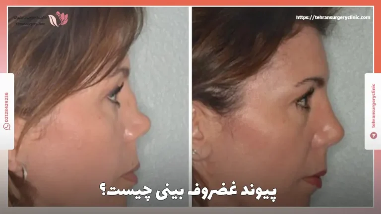 پیوند غضروف بینی: روش انجام و کاندید مناسب پیوند زدن غضروف به بینی