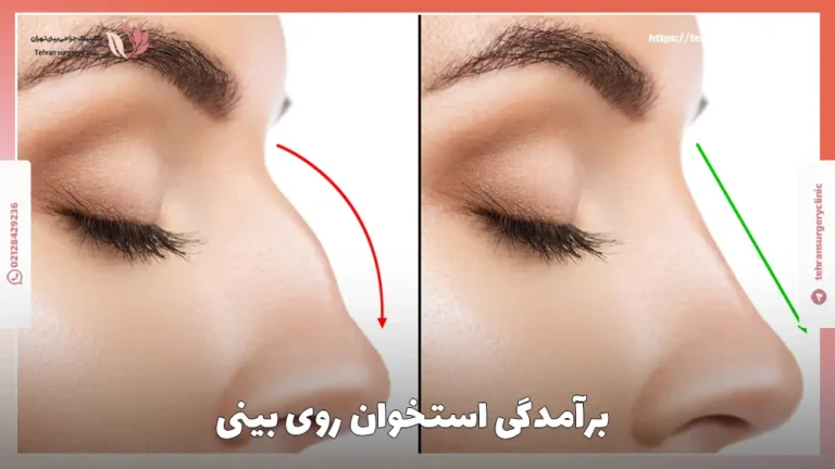 برآمدگی استخوان روی بینی: علت و خطرات و درمان آن