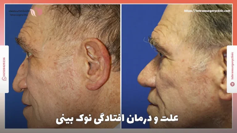 علت و روش های درمان افتادگی نوک بینی