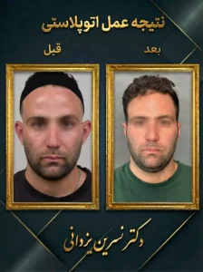 اتوپلاستی دکتر نسرین یزدانی