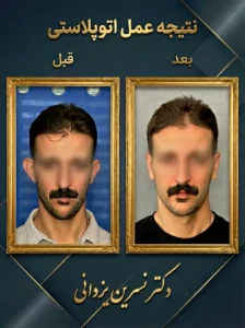 قبل و بعد عمل اتوپلاستی