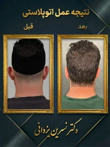 نتیجه عمل زیبایی گوش