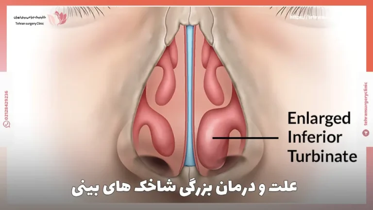بزرگی شاخک های بینی: علت، علائم و درمان هایپرتروفی توربین