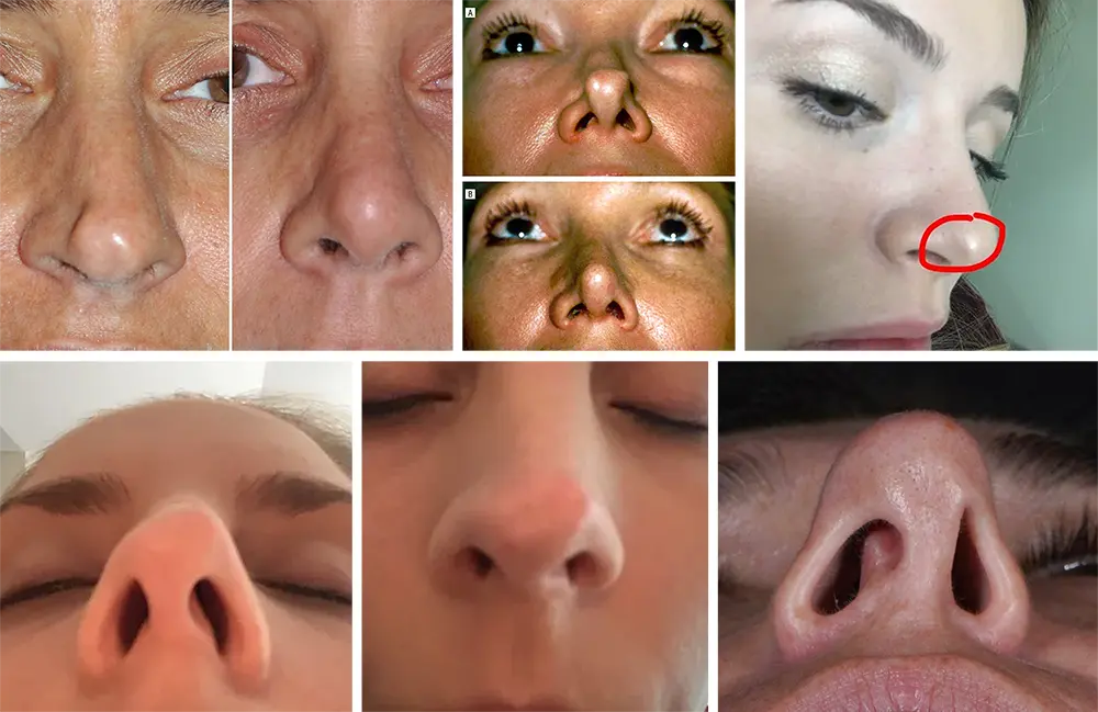 عکس بیرون زدگی غضروف بینی