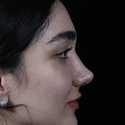 تصویر بعد رینوپلاستی