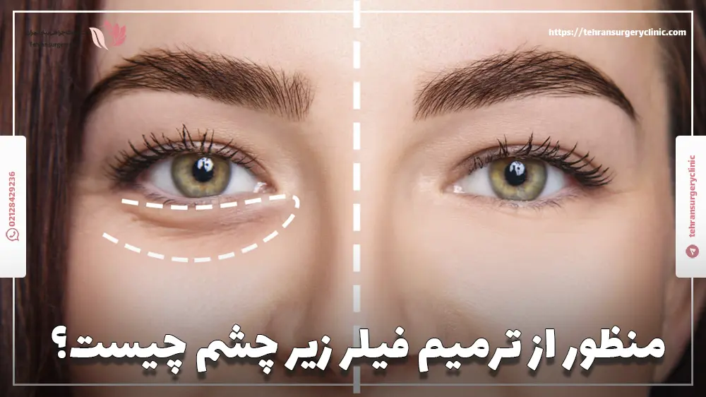 عکس قبل و بعد از خانمی که فیلر زیر چشم تزریق کرده است.