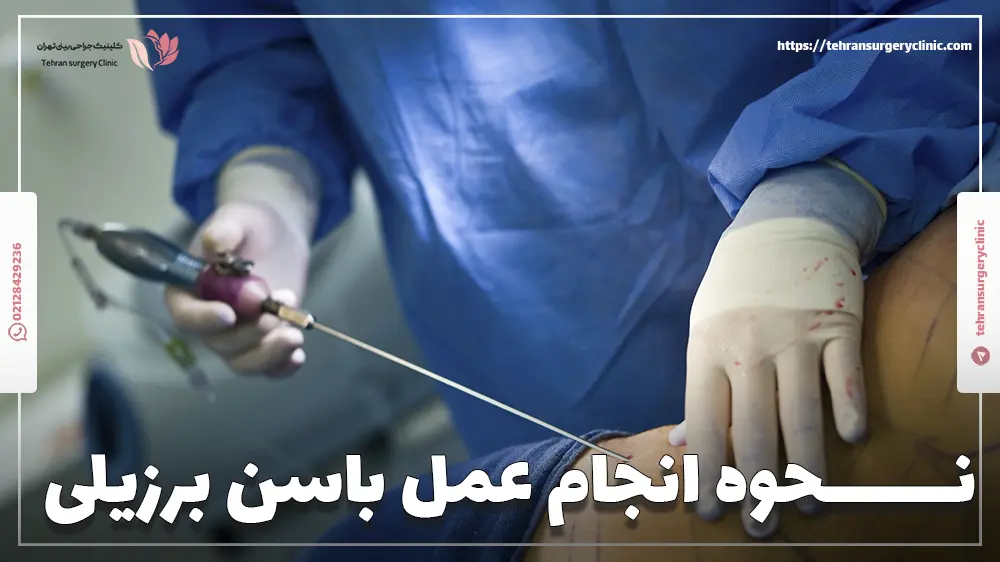 دکتر جراح متخصص باسن برزیلی در حال انجام عمل BBL