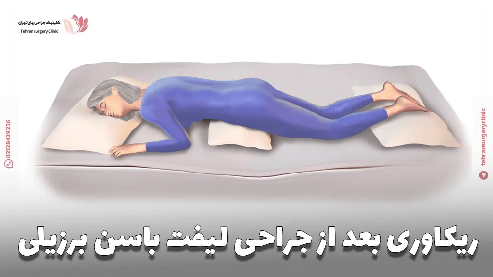 خانمی که در دوره ریکاوری بعد از عمل لیفت باسن برزیلی