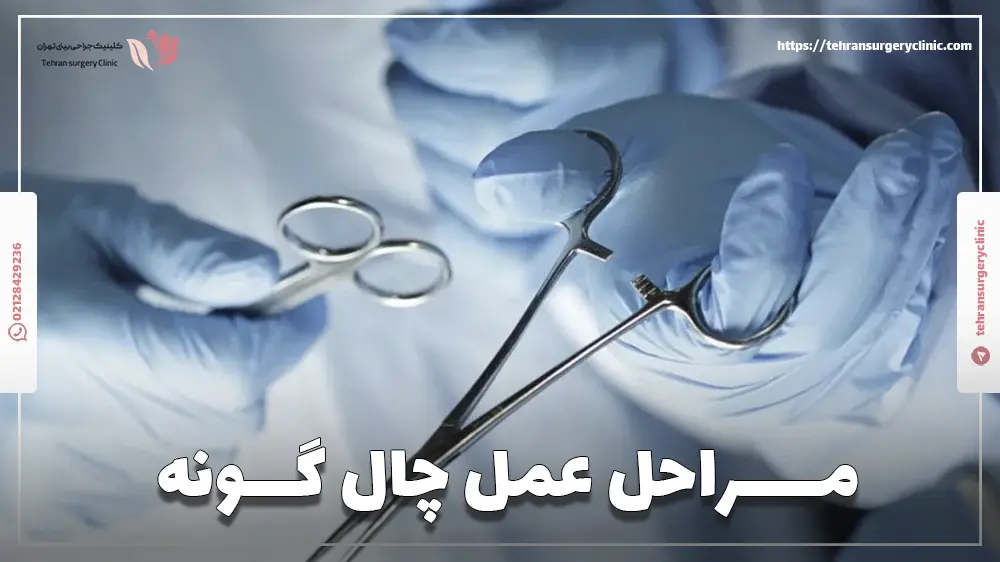 مراحل عمل چال گونه