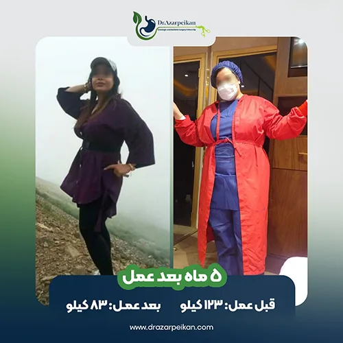 نتیجه عمل اسلیو دکتر آذرپیکان