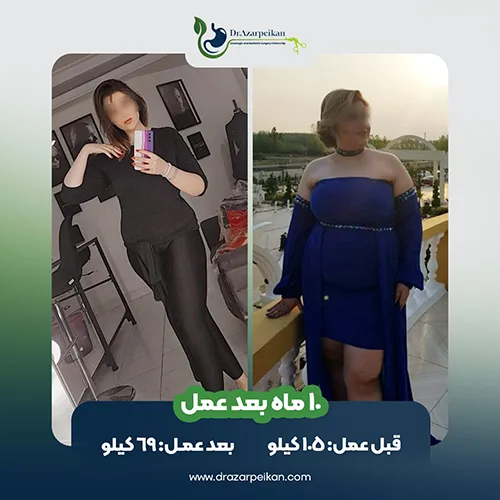 نتیجه عمل اسلیو دکتر آذرپیکان2