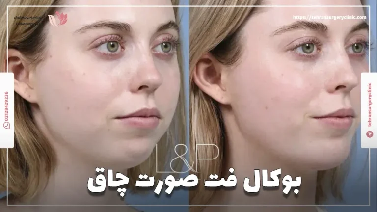 بوکال فت صورت چاق | عمل بوکال برای صورت چاق