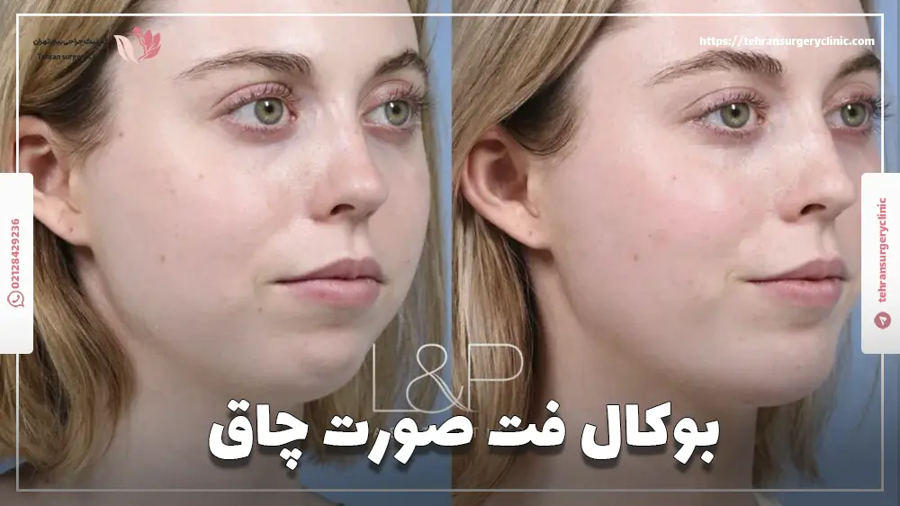 عکس قبل و بعد از یک خانم که بوکال فت صورت چاق انجام داده