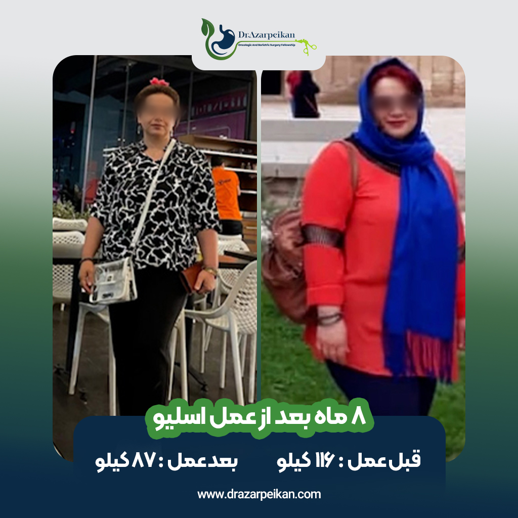 نتیجه عمل اسلیو دکتر آذرپیکان5
