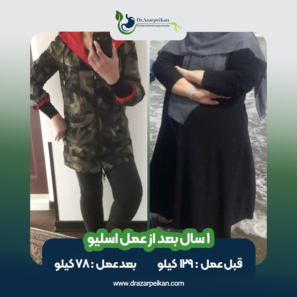 نتیجه عمل اسلیو دکتر آذرپیکان6
