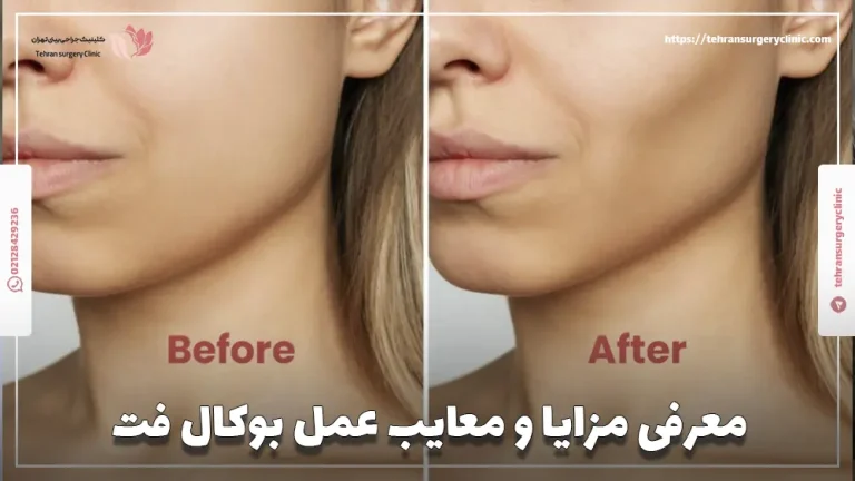معرفی 15 تا از مزایا و معایب عمل بوکال فت
