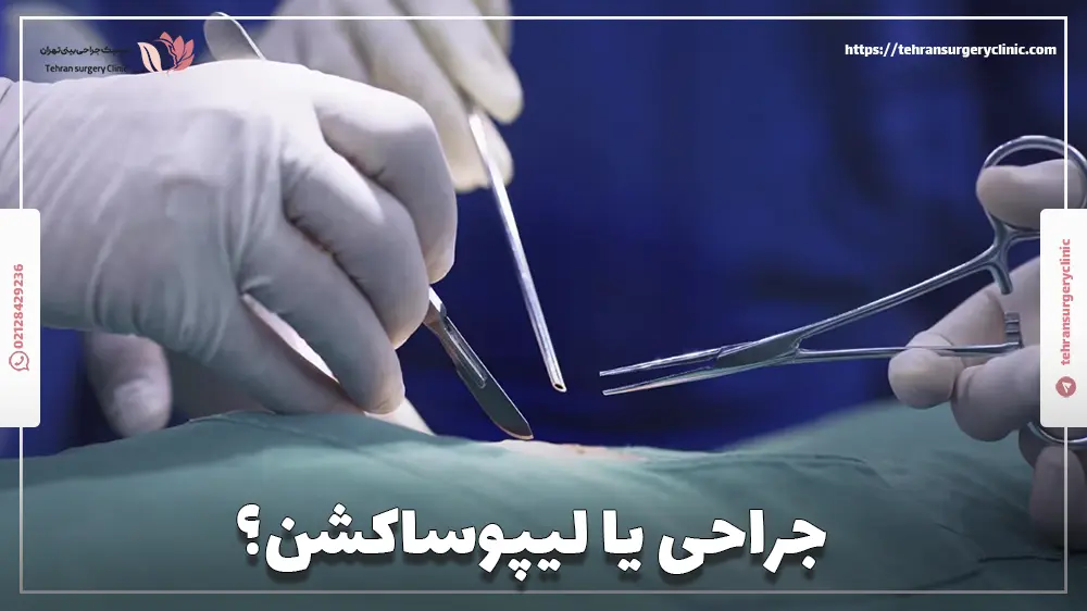 جراحی یا لیپوساکشن