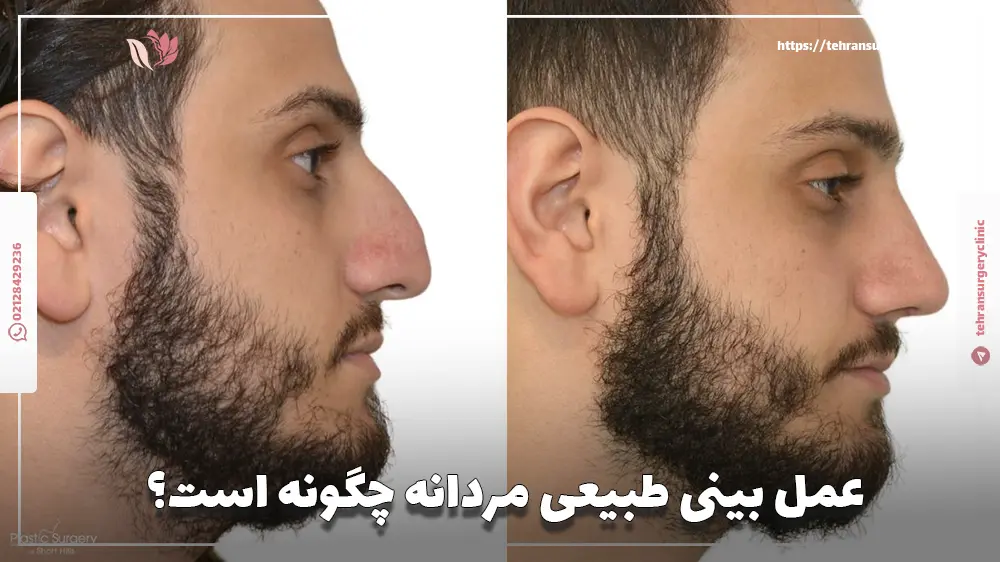 عمل بینی طبیعی مردانه چگونه است؟