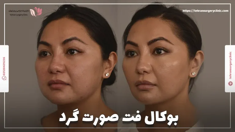 بوکال فت صورت گرد | عمل بوکال فت صورت گرد