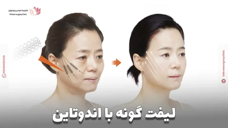 لیفت گونه با اندوتاین | مزایا، عوارض و هزینه اندوتاین گونه