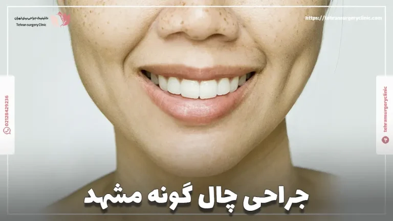 جراحی چال گونه مشهد | دکتر جراح چال گونه در مشهد