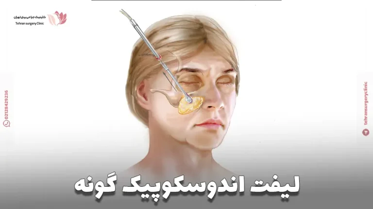 لیفت اندوسکوپیک گونه | لیفت گونه با اندوسکوپ