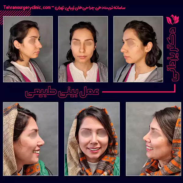 عمل بینی طبیعی بدون قوس