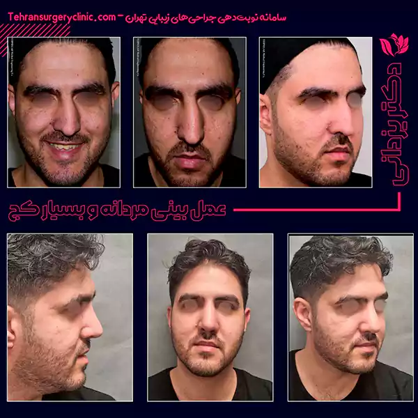 عمل بینی طبیعی مردانه