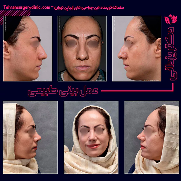 عمل بینی طبیعی با قوس ملایم