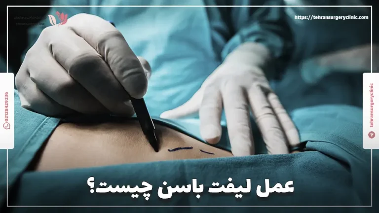 لیفت باسن | مزایا، نحوه و هزینه عمل لیفت باسن