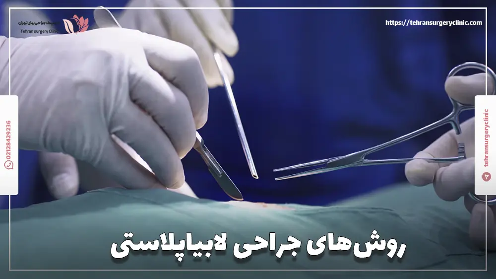 روش‌های جراحی لابیاپلاستی