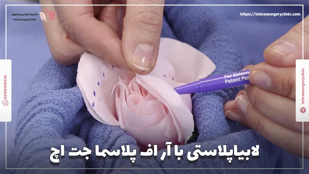 لابیاپلاستی با آر اف پلاسما جت اچ