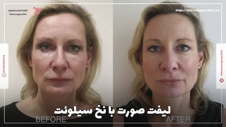 لیفت صورت با نخ سیلوئت: مزایا، ماندگاری و هزینه لیفت سیلوئت