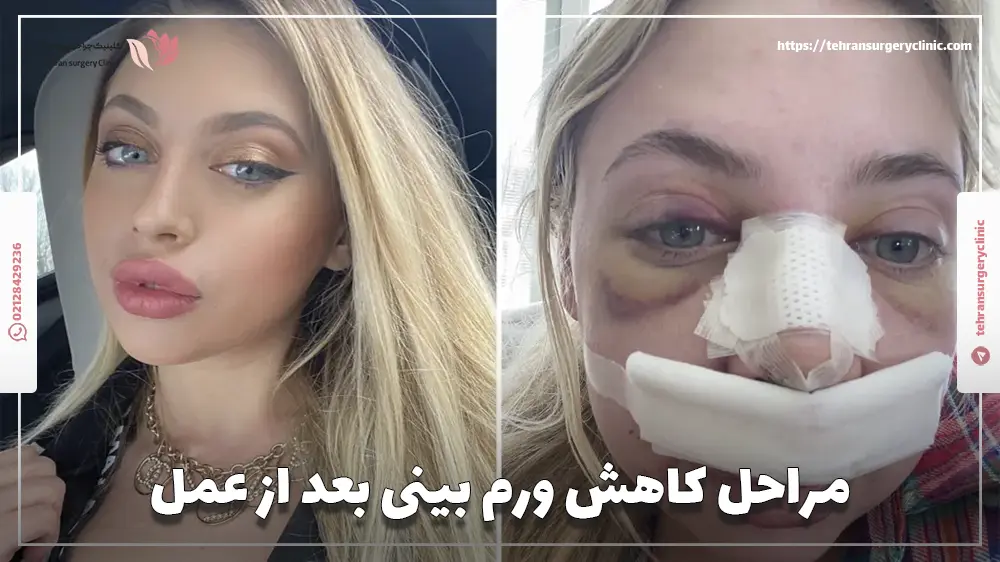 مراحل کاهش ورم بینی بعد از عمل