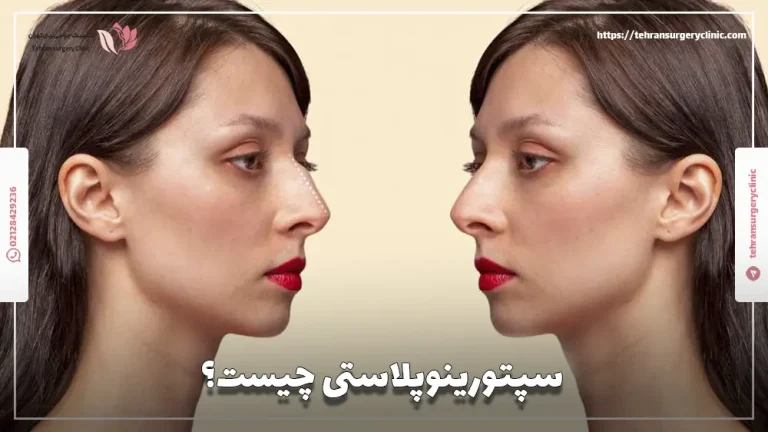سپتورینوپلاستی چیست؟ | کاربرد و هزینه عمل سپتورینوپلاستی