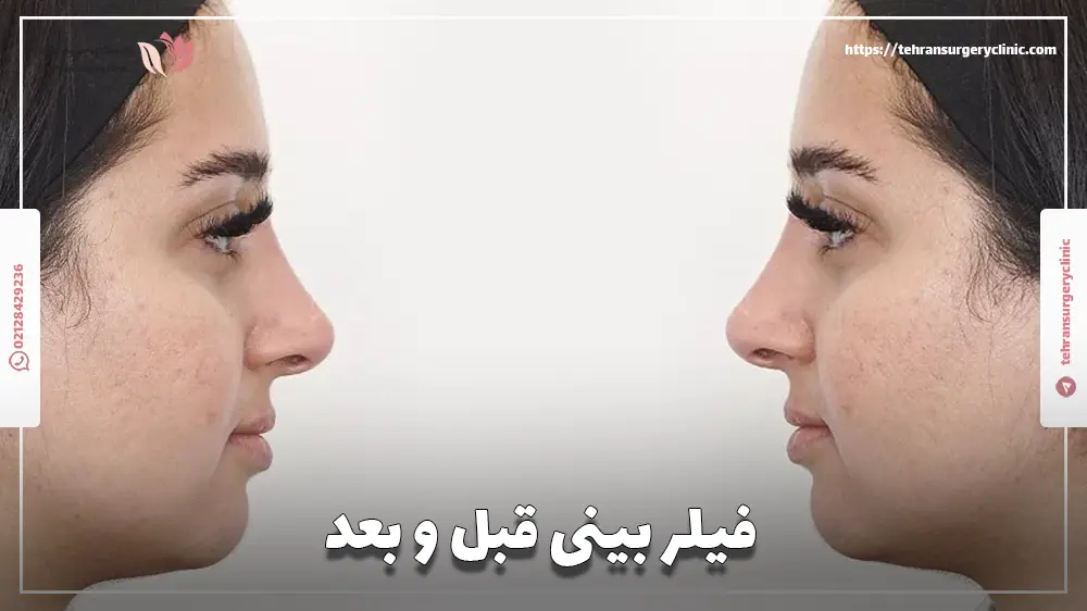 عکس فیلر بینی قبل و بعد