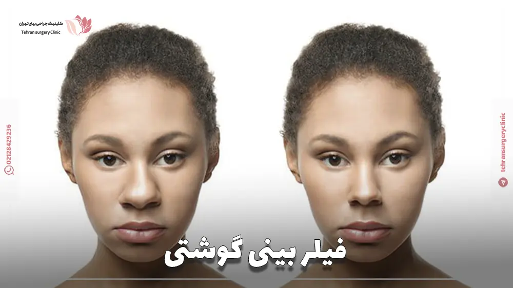 عکس فیلر بینی گوشتی