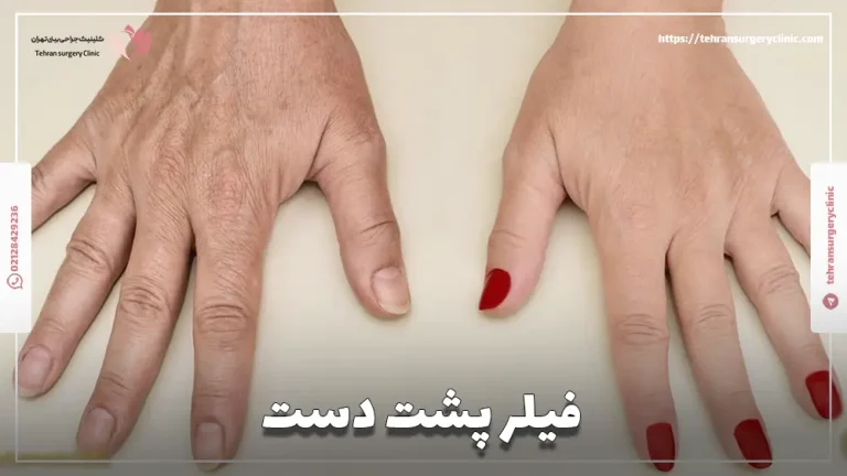 فیلر پشت دست: کاربرد، عوارض و هزینه تزریق ژل به دست