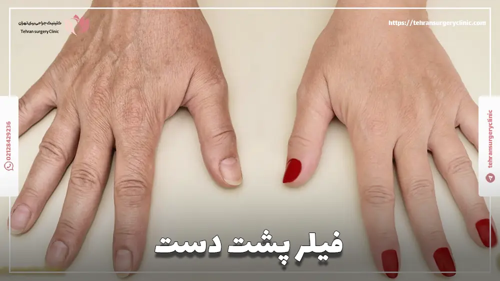 فیلر پشت دست