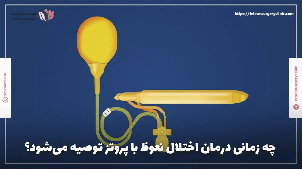 چه زمانی درمان اختلال نعوظ با پروتز توصیه می‌شود؟