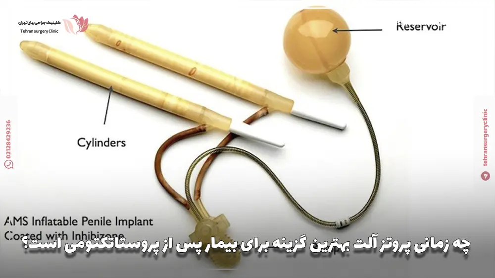 چه زمانی پروتز آلت بهترین گزینه برای بیمار پس از پروستاتکتومی است؟