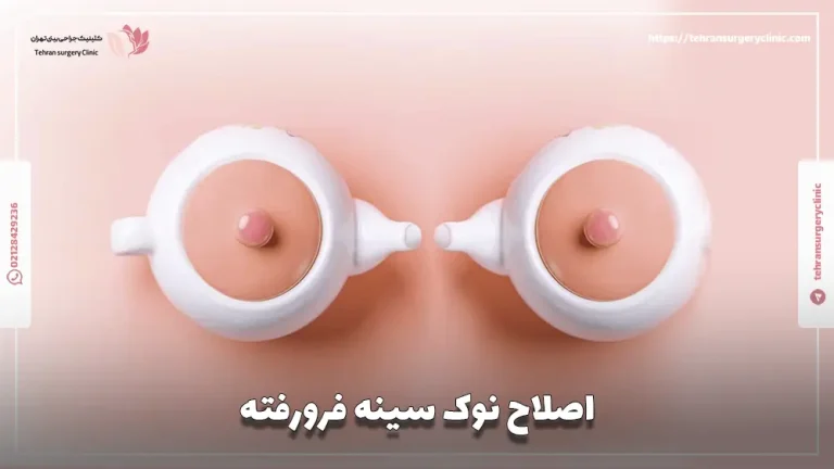 اصلاح نوک سینه فرورفته: روش های درمان نیپل فرو رفته