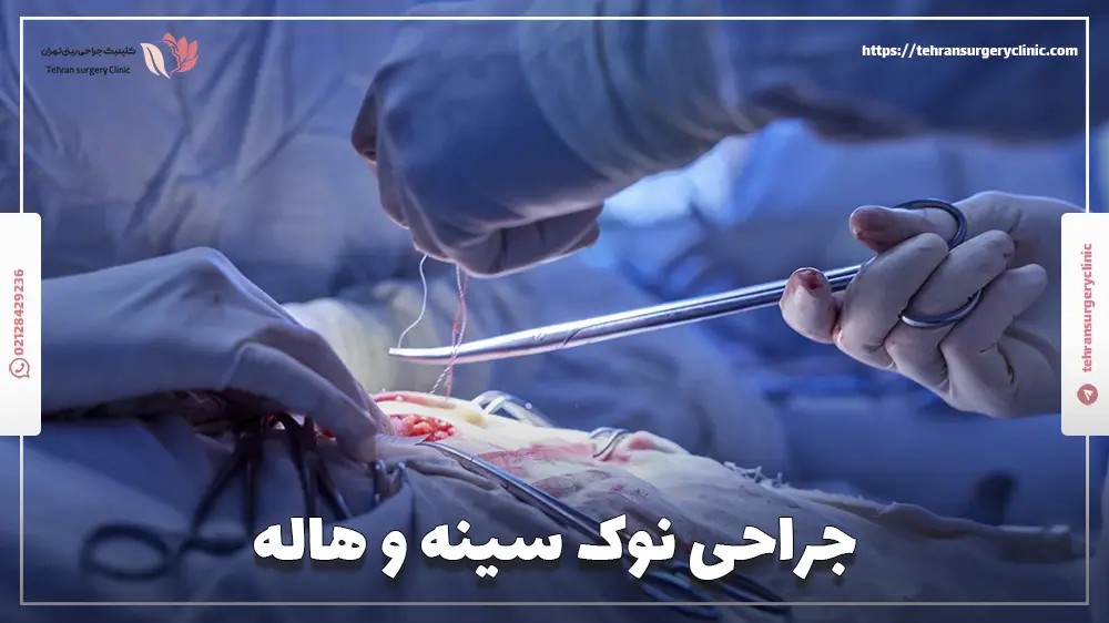 جراحی نوک سینه و هاله