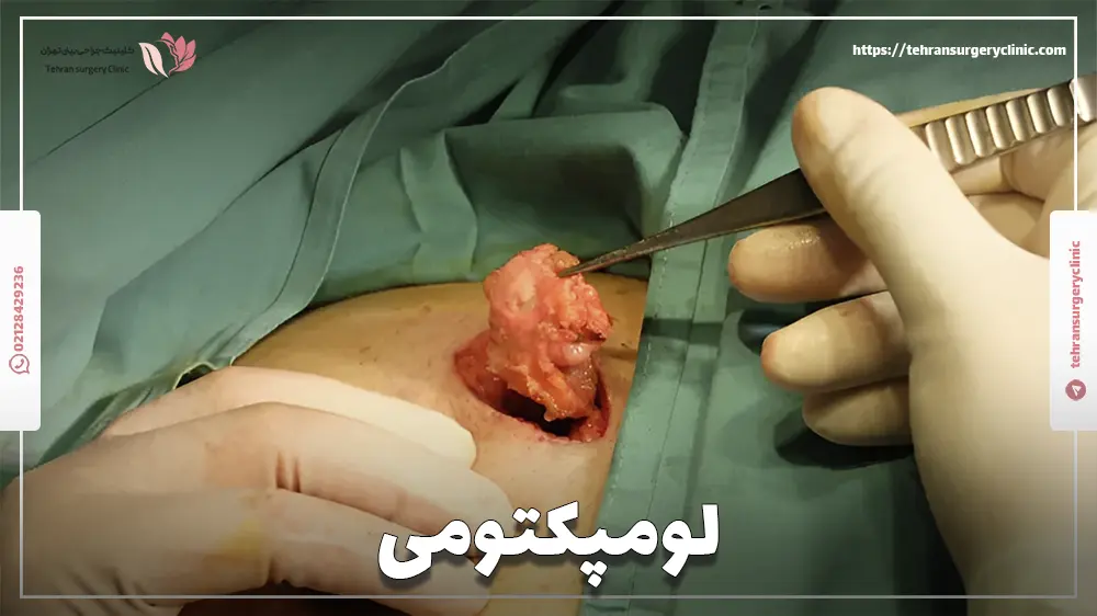 لومپکتومی
