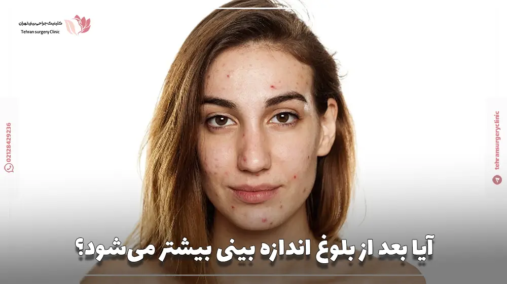 آیا بعد از بلوغ اندازه بینی بیشتر می‌شود؟