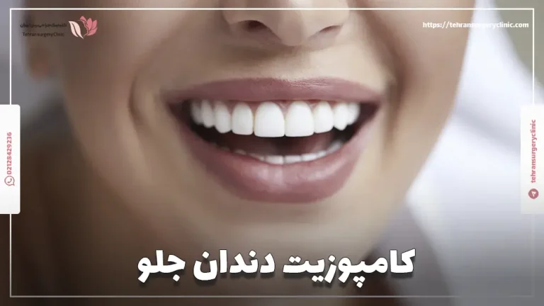کامپوزیت دندان جلو: مراحل، عمر و قیمت کامپوزیت دندان های جلو