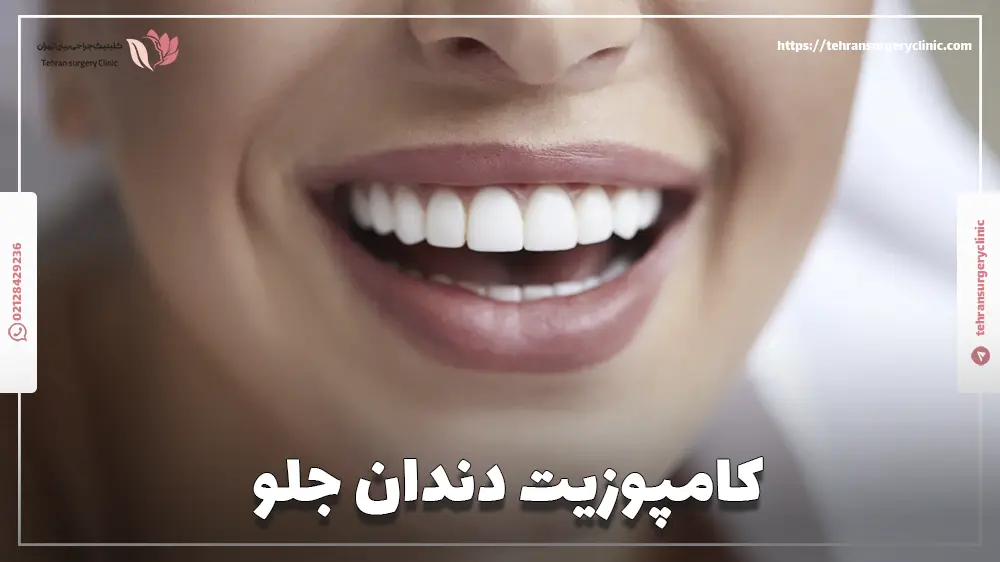 کامپوزیت دندان جلو