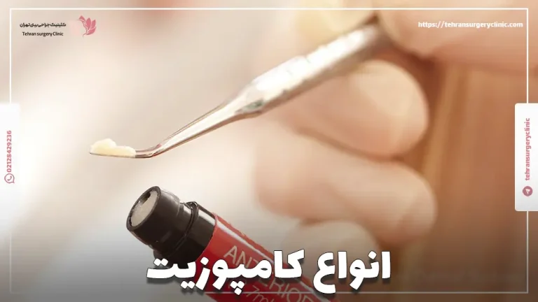 انواع کامپوزیت | بهترین نوع کامپوزیت کدام است؟